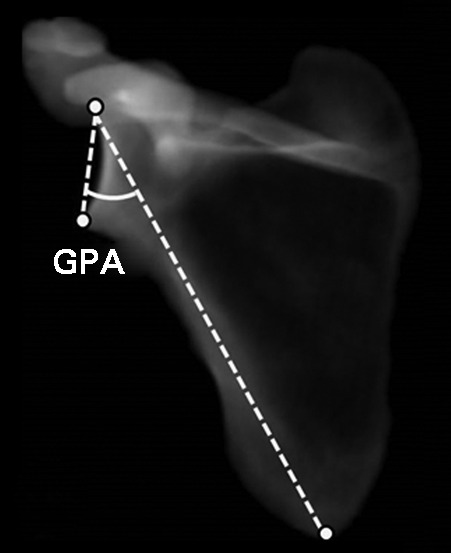 Comparison Of Measurements Of The Glenopolar Angle In 3d Ct 