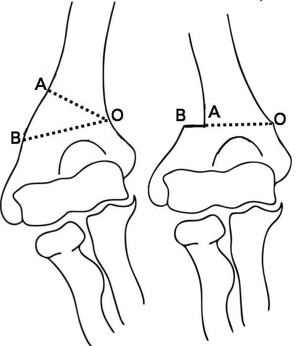 Lateral Closing Isosceles Triangular Osteotomy For The Treatment Of A