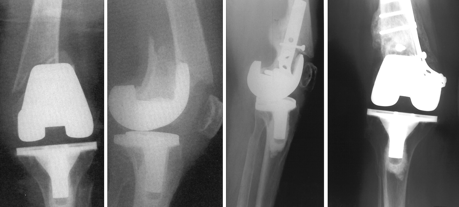 Periprosthetic Fractures Associated With Total Knee Arthroplasty | Bone ...