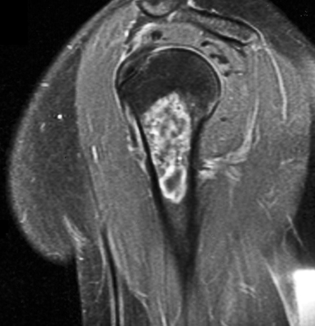 MRI appearances of atypical cartilaginous tumour/grade I chondrosarcoma ...