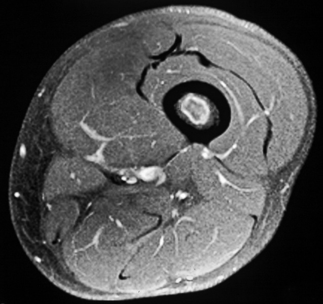 MRI appearances of atypical cartilaginous tumour/grade I chondrosarcoma ...