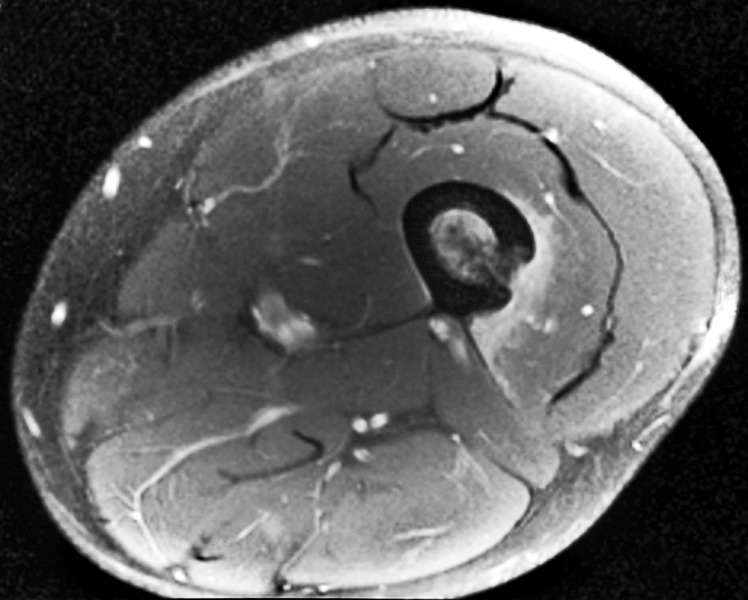 MRI appearances of atypical cartilaginous tumour/grade I chondrosarcoma ...