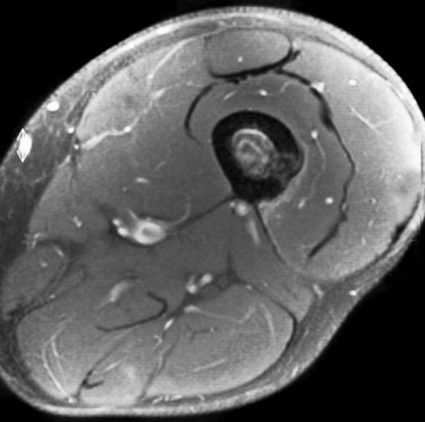 MRI appearances of atypical cartilaginous tumour/grade I chondrosarcoma ...