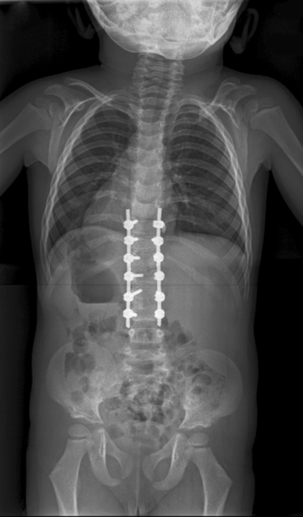 Thoracolumbar kyphosis in patients with mucopolysaccharidoses | Bone ...