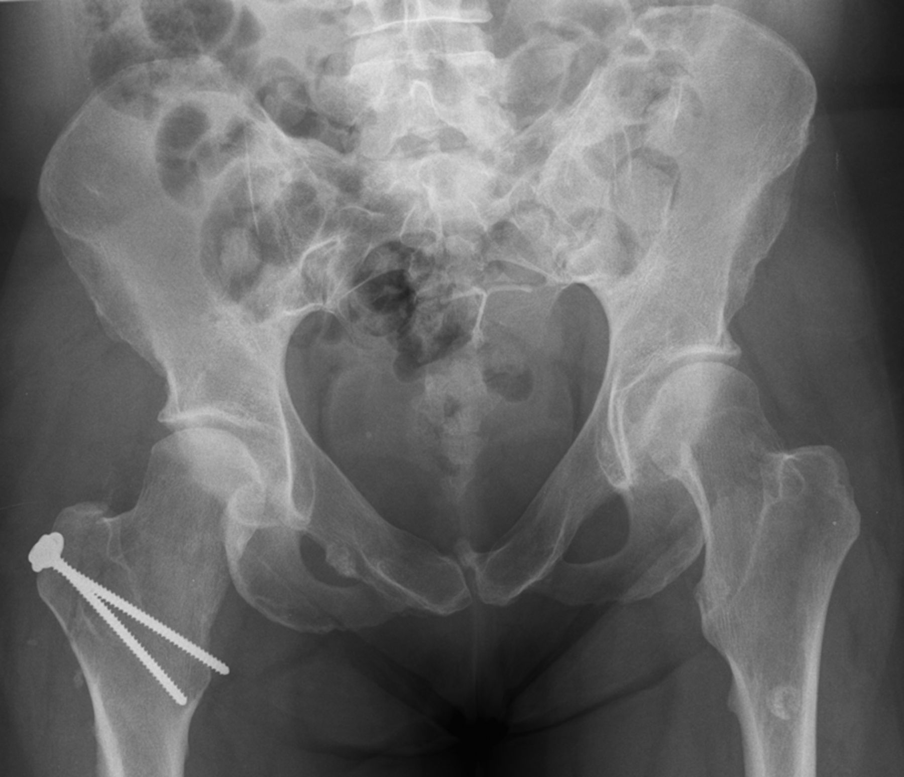 Surgical hip dislocation according to Ganz for excision of ...