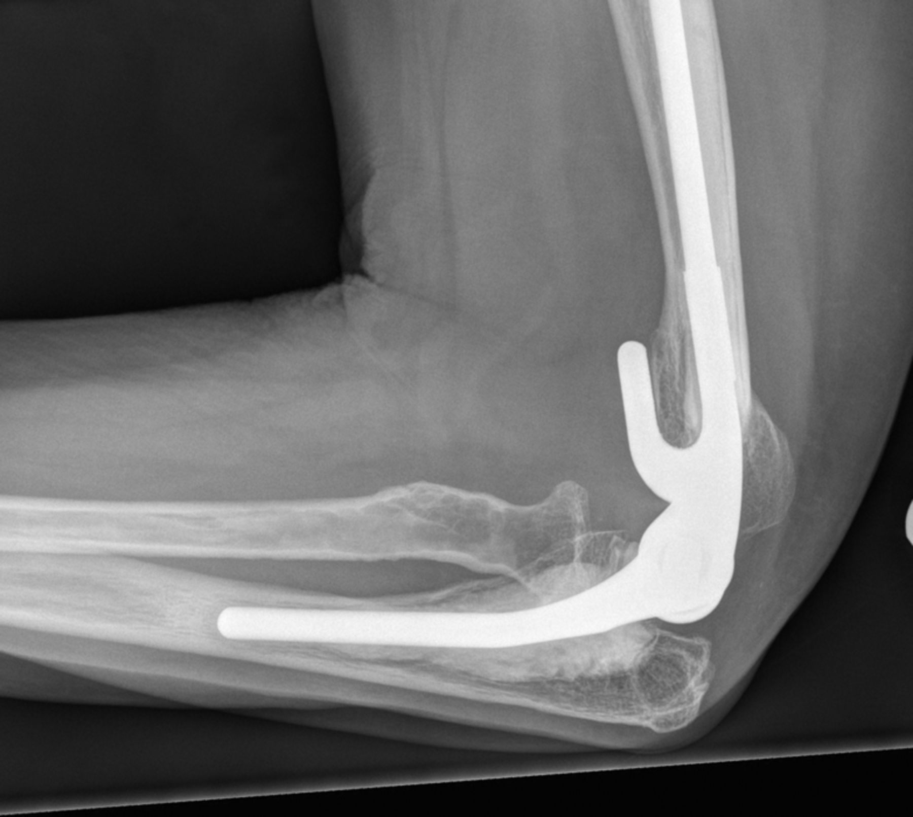 Total elbow arthroplasty for non-rheumatoid patients with a fracture of ...