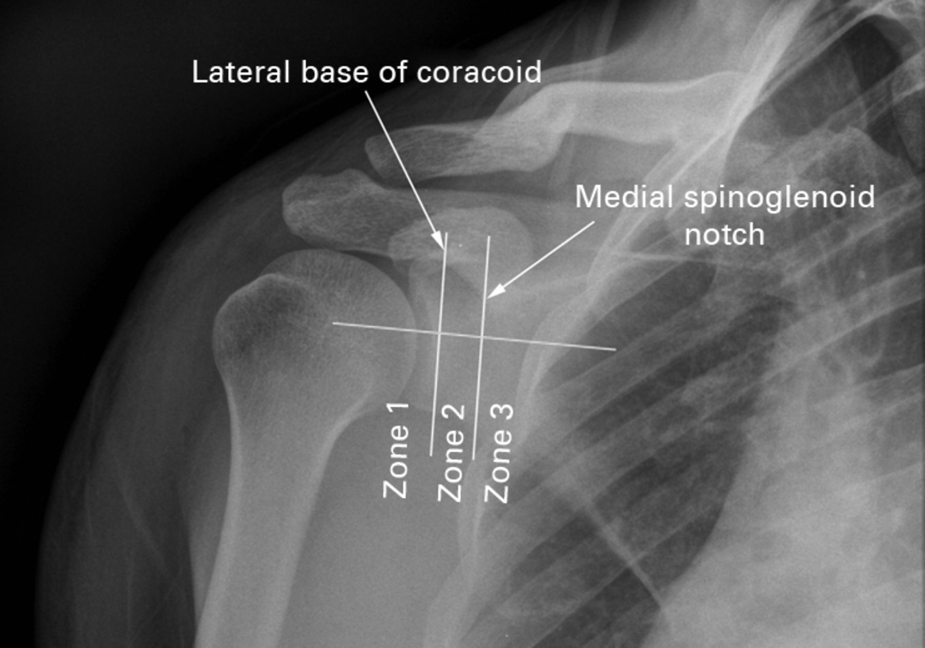 A new classification of glenoid bone loss to help plan the implantation ...