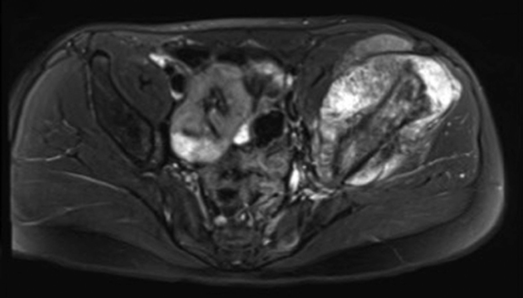 Osteosarcoma of the pelvis | Bone & Joint