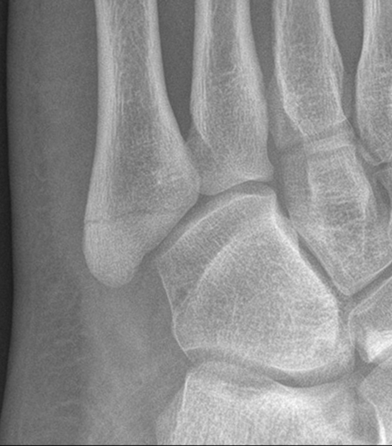 Symptomatic treatment or cast immobilisation for avulsion fractures of ...