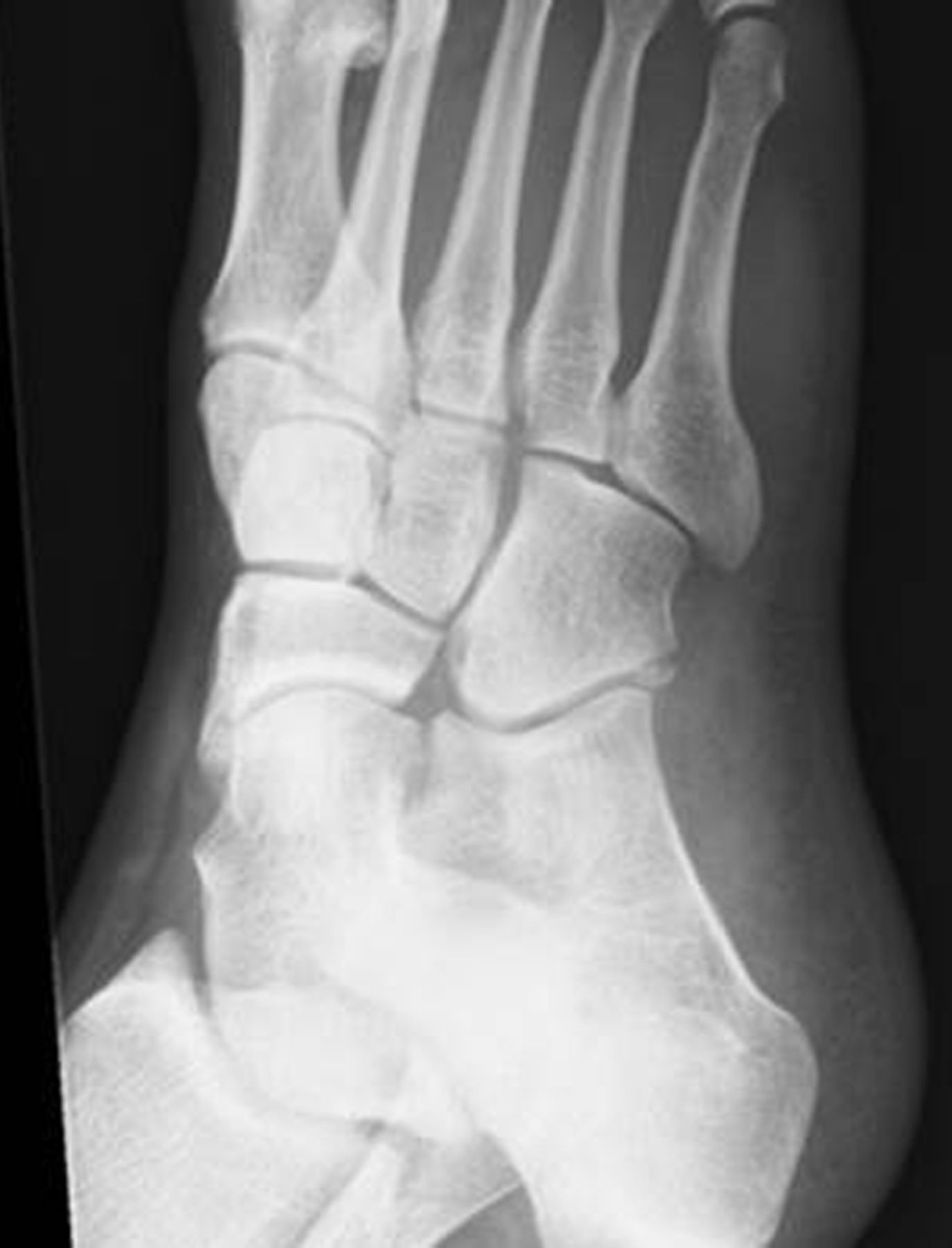 The Patterns Of Injury And Management Of Cuboid Fractures Bone And Joint