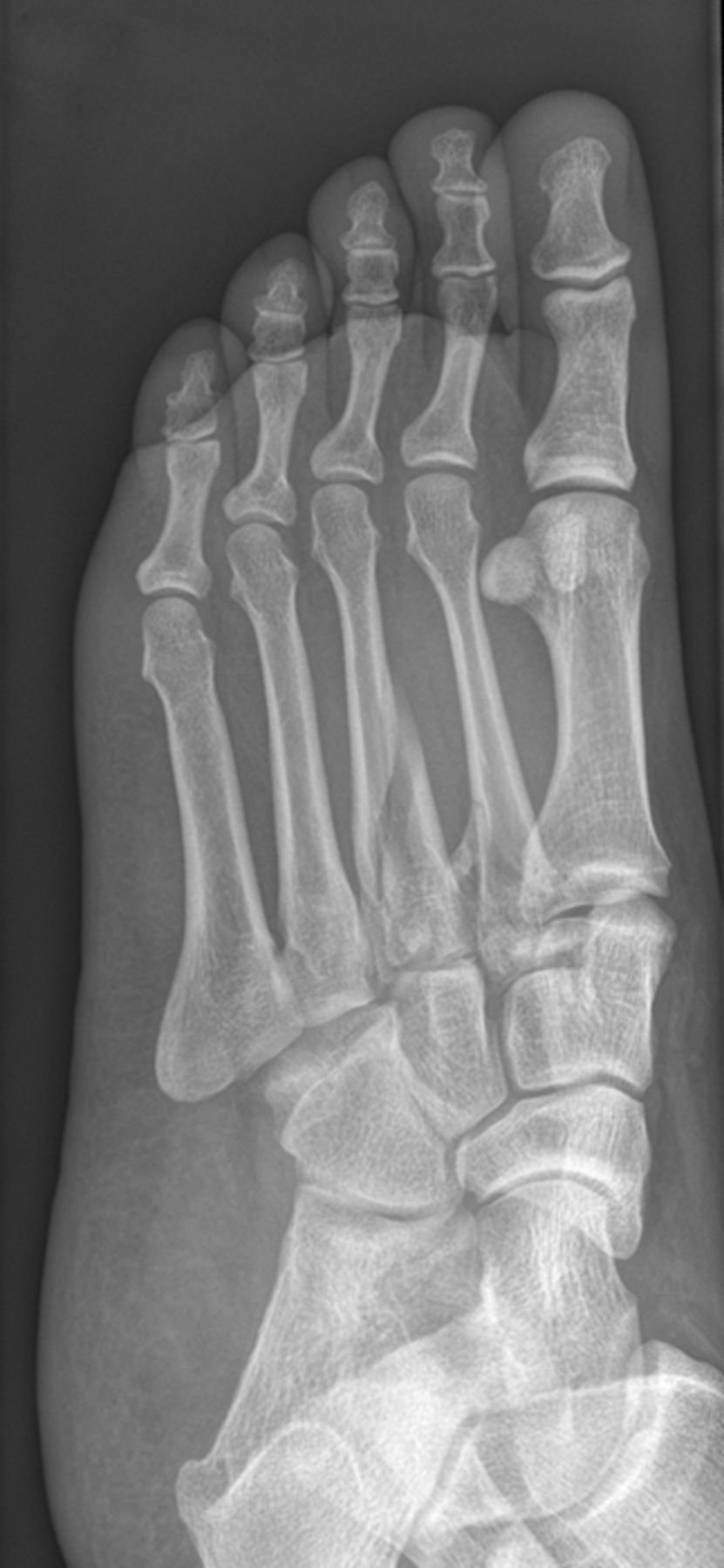 The patterns of injury and management of cuboid fractures | Bone & Joint
