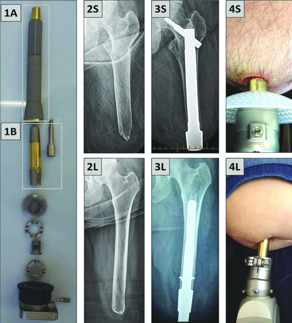 The Osseointegration Group Of Australia Accelerated Protocol (OGAAP-1 ...