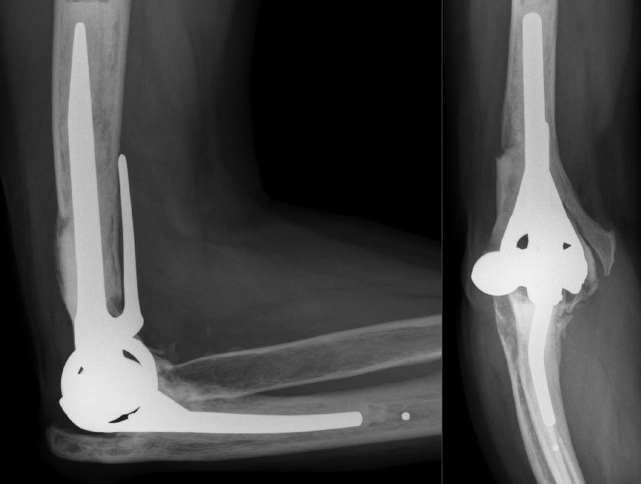 Short-term clinical results of revision elbow arthroplasty using the ...