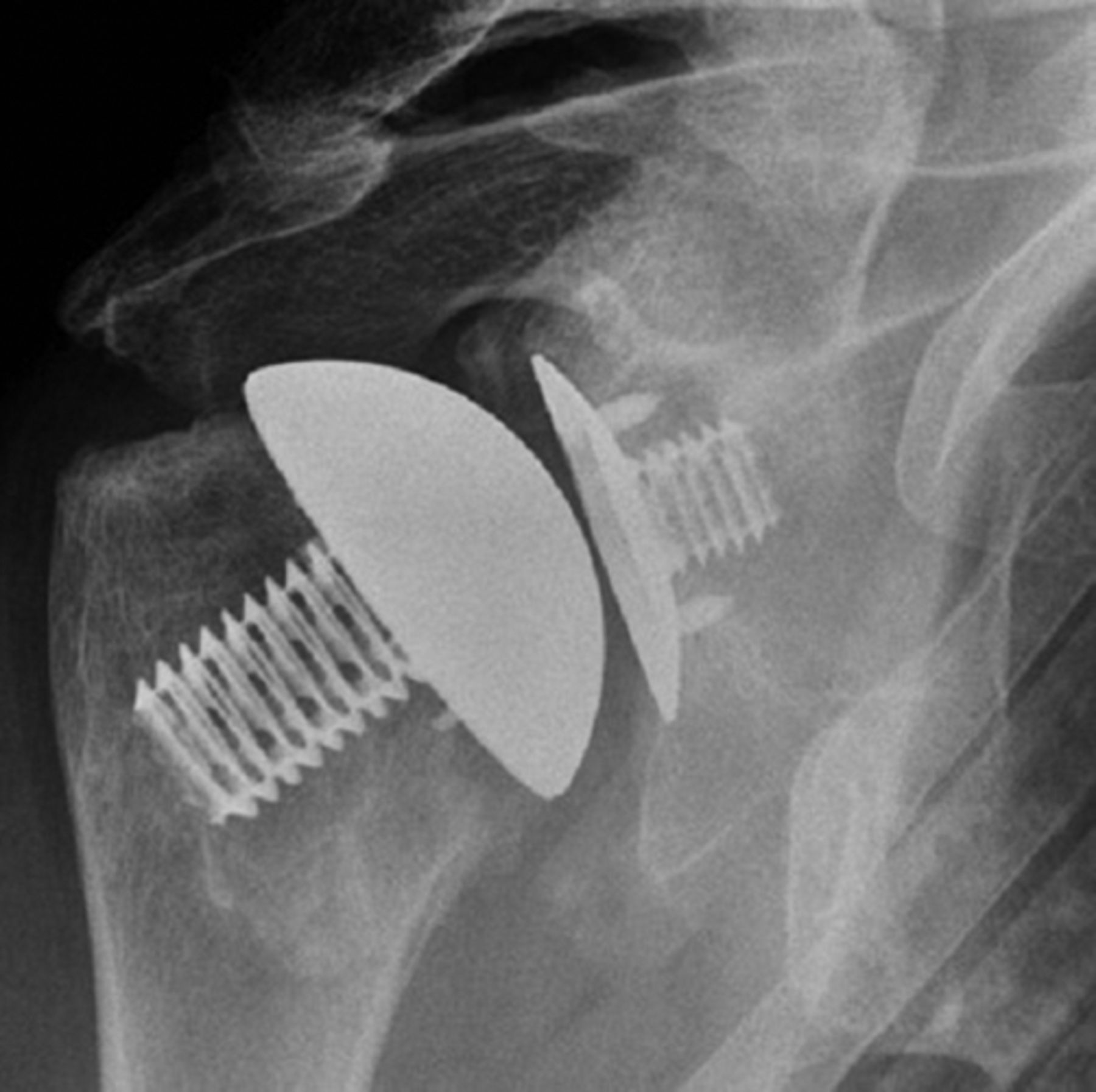 Results Of Non Operative Treatment Of Fractures Of The Glenoid Fossa Bone Joint