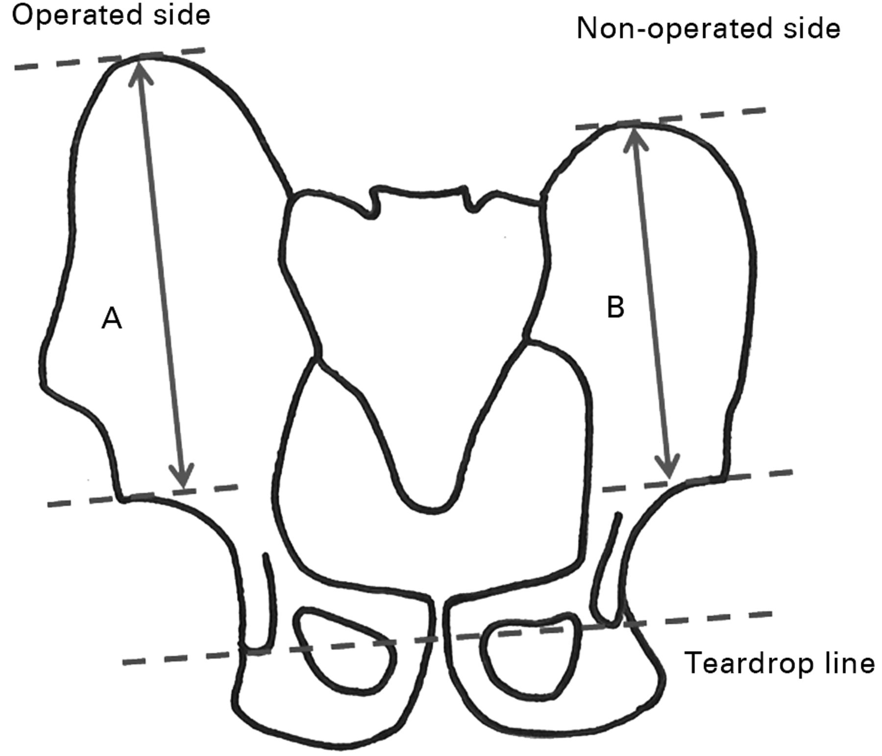 The comparative, long-term effect of the Salter osteotomy and Pemberton ...