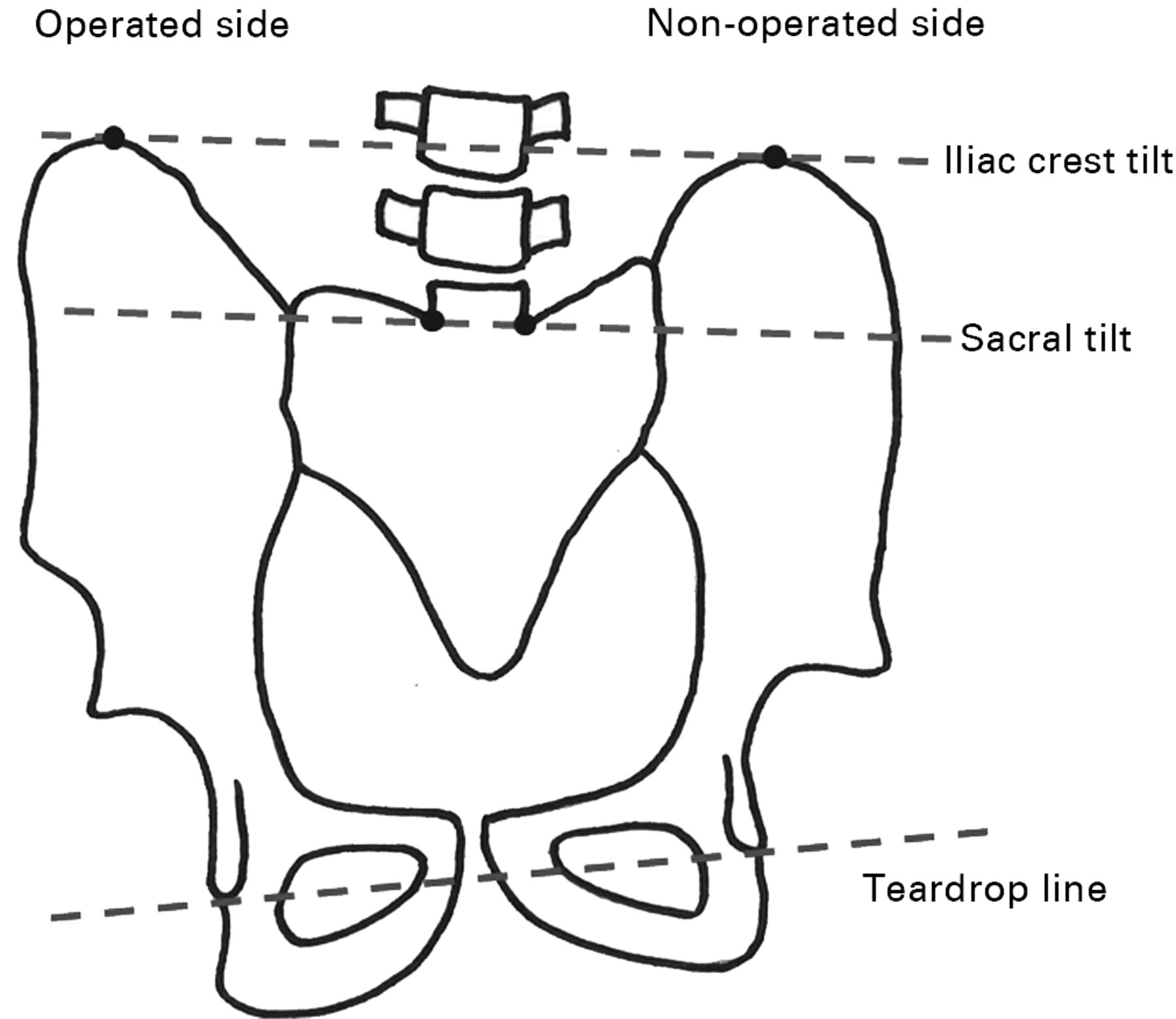 The Comparative Long Term Effect Of The Salter Osteotomy And Pemberton Acetabuloplasty On 1398