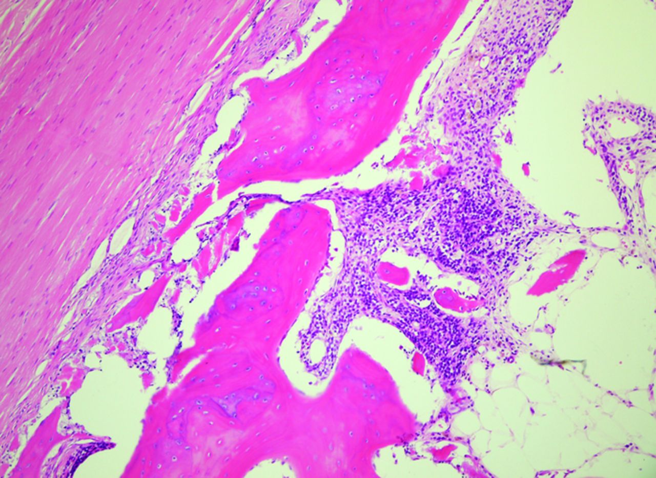 Ewings Sarcoma Bone And Joint 4642