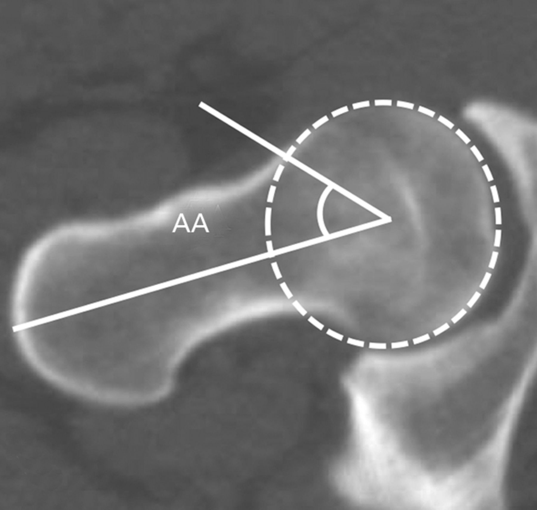 Ct Based Morphological Assessment Of The Hip Joint In Japanese Patients Bone And Joint 6857