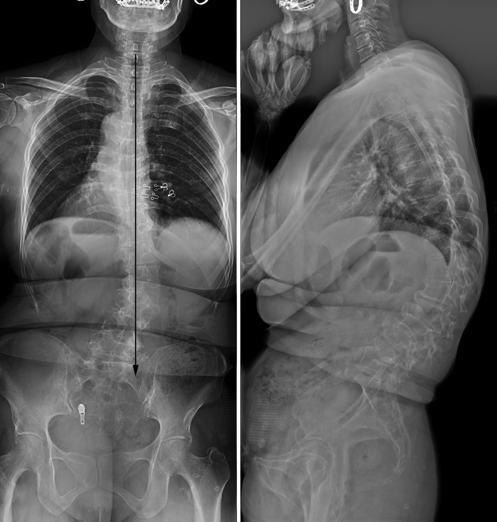 Coronal imbalance in degenerative lumbar scoliosis | Bone & Joint