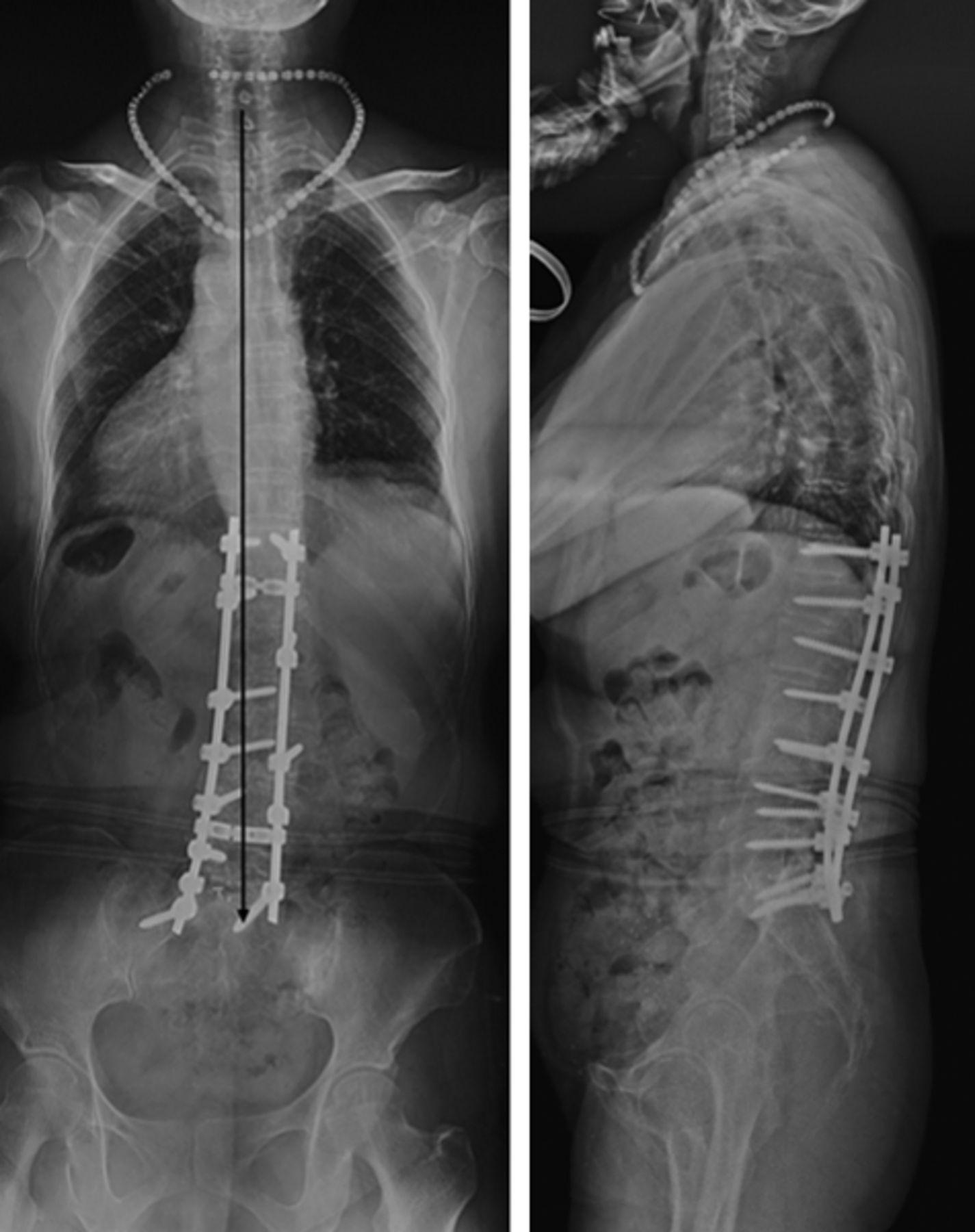 Coronal imbalance in degenerative lumbar scoliosis | Bone & Joint