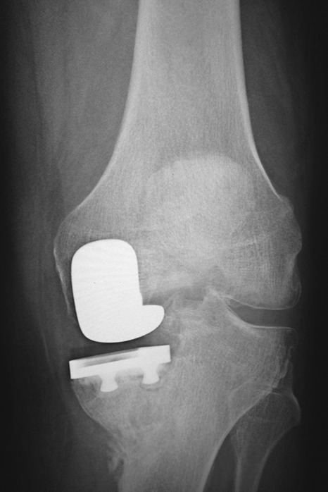 Conversion of a unicompartmental knee arthroplasty to a total knee ...