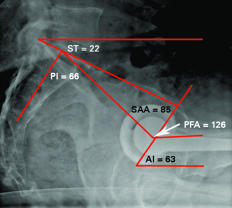 Figs. 2a - 2b 
          a) Post-operative standing lateral
spinopelvic-hip radiograph of hypermobile flex construct: pelvic
incidence (PI) 66o (high PI). Sacral tilt (ST) 55o (high).
Intra-operative computer navigation acetabular component positions:
inclination 35o, anteversion 21o, combined
anteversion 33o results in normal sagittal component
positions: ante-inclination (AI) 30o, sacral acetabular
angle (SAA) 85o, pelvic femoral angle (PFA) 181o.
b) Post-operative sitting lateral spinopelvic-hip of hypermobile-flex
construct: ST 22o so ∆ST 33o (high). AI 63o;
SAA 85o; PFA 126o (all normal for hypermobile
patients).
        