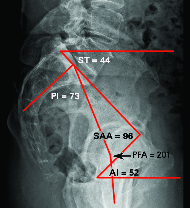 Figs. 3a - 3b 
          a) Standing lateral spinopelvic-hip
radiograph fixed with anterior tilt (stuck standing). Pelvic incidence
(PI) 73o (high PI); sacral tilt (ST) 44o;
sacral acetabular angle (SAA) 96o; ante-inclination (AI)
52o; pelvic femoral angle (PFA) 201o (SAA
and PFA are abnormally high). b) Sitting lateral spinopelvic-hip
radiograph fixed with anterior tilt: ST 39o so ∆ST 5o (biological fusion).
AI 57o; PFA 122o (both normal). At surgery
the acetabular component was placed at 42o inclination,
20o anteversion with combined anteversion of 40o.
With these acetabular component numbers the post-operative AI and
SAA were normal for both standing and sitting. 
        