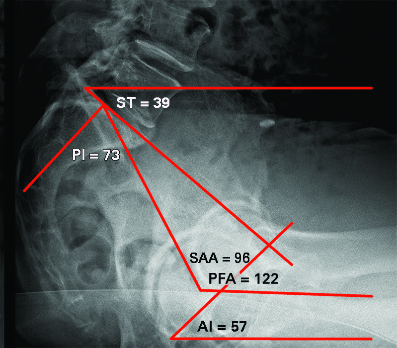 Figs. 3a - 3b 
          a) Standing lateral spinopelvic-hip
radiograph fixed with anterior tilt (stuck standing). Pelvic incidence
(PI) 73o (high PI); sacral tilt (ST) 44o;
sacral acetabular angle (SAA) 96o; ante-inclination (AI)
52o; pelvic femoral angle (PFA) 201o (SAA
and PFA are abnormally high). b) Sitting lateral spinopelvic-hip
radiograph fixed with anterior tilt: ST 39o so ∆ST 5o (biological fusion).
AI 57o; PFA 122o (both normal). At surgery
the acetabular component was placed at 42o inclination,
20o anteversion with combined anteversion of 40o.
With these acetabular component numbers the post-operative AI and
SAA were normal for both standing and sitting. 
        
