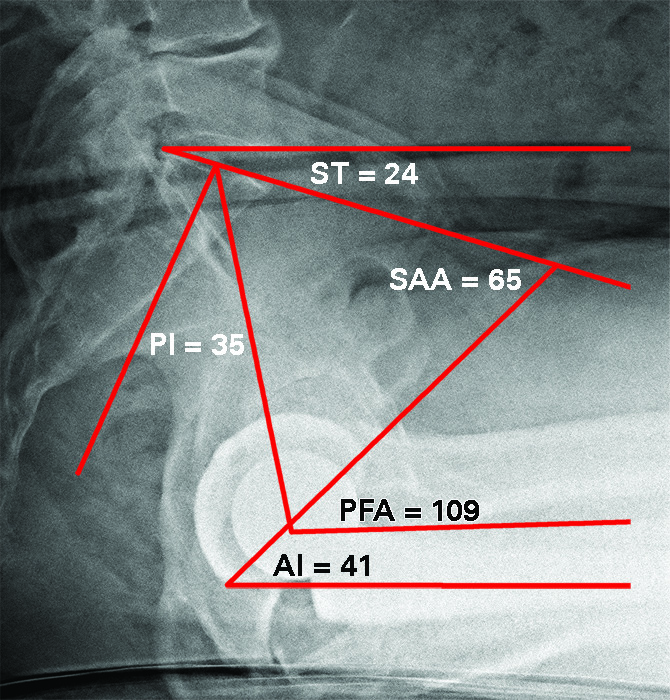 Figs. 4a - 4b 
          a) Post-operative standing lateral
spinopelvic-hip radiograph of construct fixed in posterior tilt
and stiff: Pelvic incidence (PI) 35o (low PI); sacral
tilt (ST) 27o which means this structure is stuck sitting.
Computer navigation intra-operative component position: inclination
45o, anteversion 21o and combined anteversion
33o results in normal sagittal implant position: ante-inclination
(AI) 38o, sacral acetabular angle (SAA) 65o and
pelvic femoral angle (PFA) 186o. b) Post-operative sitting lateral
spinopelvic-hip radiograph of construct fixed in posterior tilt:
ST 24o so ∆ST 3o (fusion). AI 41o so ∆AI
3o (stiff acetabulum). PFA 109o which is more
flexion than normal because all movement must occur at the hip.
This hip remains at risk for impingement even with correct acetabular
component angles.
        