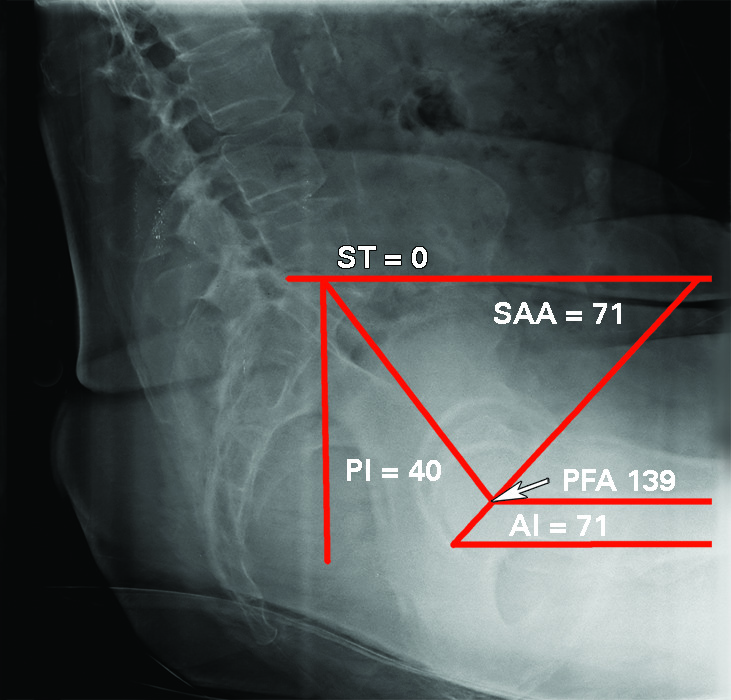 Figs. 5a - 5b 
          a) Post-operative anterior-posterior
radiograph showing a dislocation. Intra-operative computer navigation
component position: inclination 38o, anteversion 23o,
combined anteversion 33o. This component position gave
normal skeletal and sagittal acetabular component positions on the
post-operative lateral spinopelvic radiograph. b) Pre-operative
sitting spinopelvic hip radiograph of same patient shows kyphotic
spine position. The sacral tilt 0o.
        