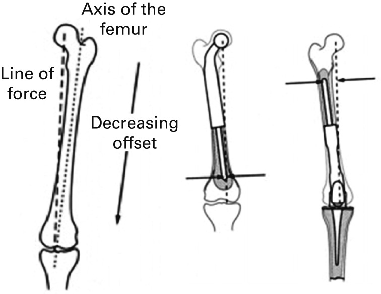 Minimising aseptic loosening in extreme bone resections | Bone & Joint