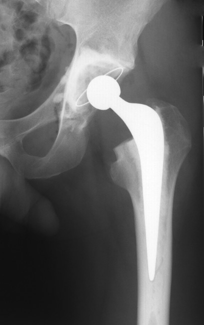 Results of the cemented Exeter femoral component in patients under the ...