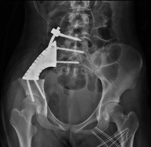 Reconstruction with 3D-printed pelvic endoprostheses after resection of ...