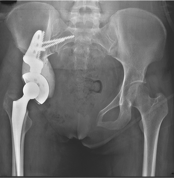 Reconstruction with 3D-printed pelvic endoprostheses after resection of ...