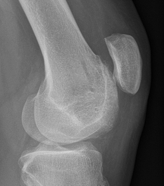 Trochleoplasty with a flexible osteochondral flap | Bone & Joint