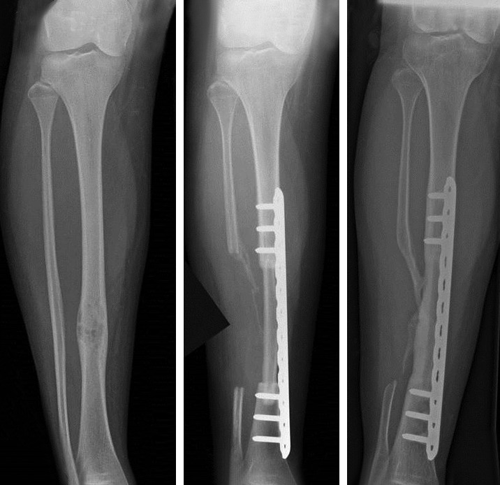 Does osteofibrous dysplasia progress to adamantinoma and how should ...