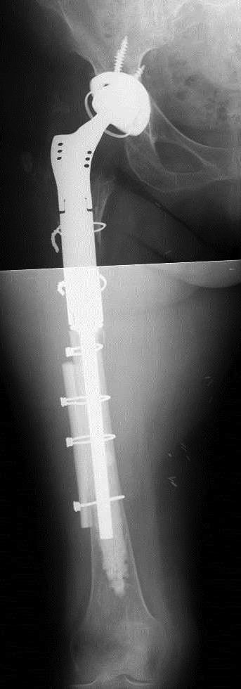 Proximal Femoral Replacement In Contemporary Revision Total Hip Arthroplasty For Severe Femoral 5902