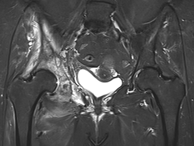 Pelvic reconstruction following resection#N#of malignant bone tumours ...