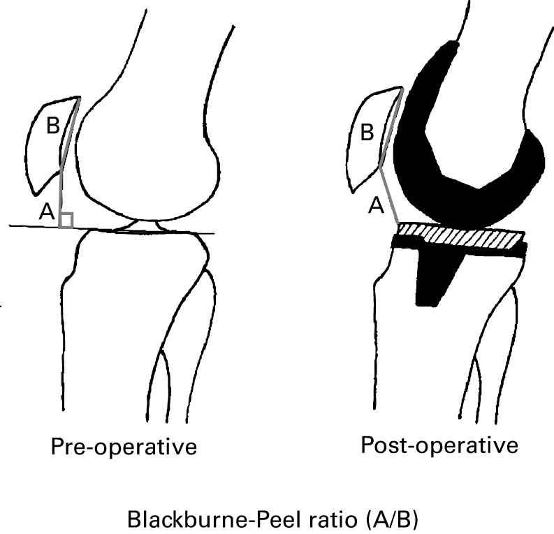 Proximalisation of the tibial tubercle gives a good outcome in patients ...