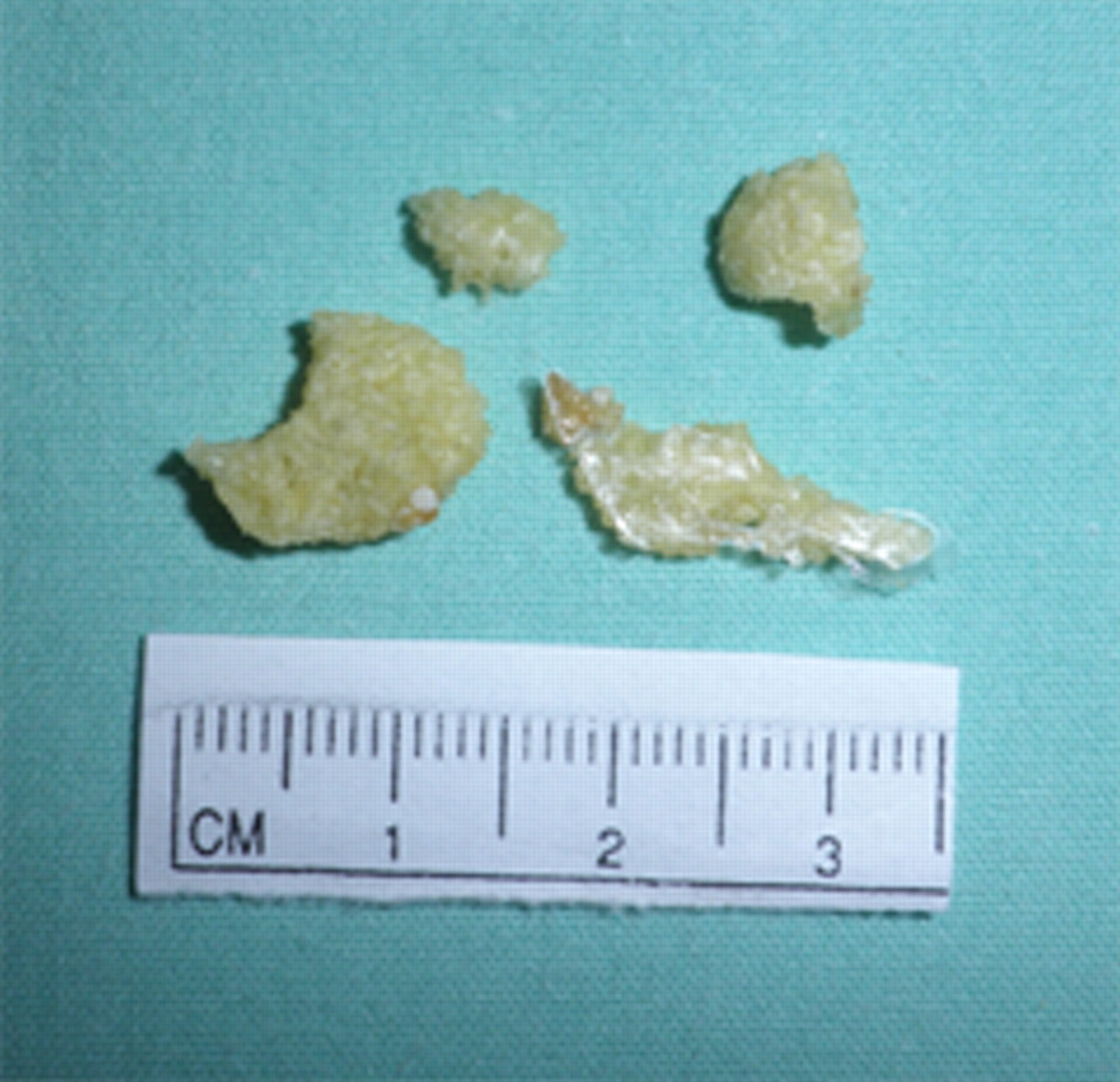Fig. 8 
          Photograph showing the macroscopic appearance
of the samples of generated tissue: solid pieces with maximum diameter
of 20 mm.
        