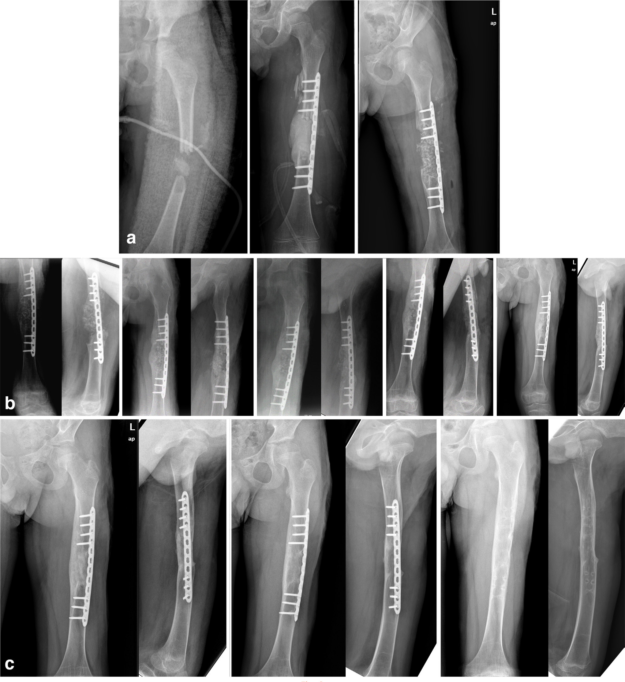 Fig. 3 
          Radiographs demonstrating the healing process of an eight-year-old male patient with a bone volume defect of 45 ml in Group BMCA. a) Anteroposterior (AP) radiographs before first operation, after first operation, and after second operation. b) AP and lateral radiographs from 1, 2, 3, 4, and 6 months postoperatively, demonstrating bony consolidation in the fourth month. c) AP and lateral radiographs from 1, 2, and 3 years postoperatively. BMCA, bone marrow concentrator modified allograft.
        