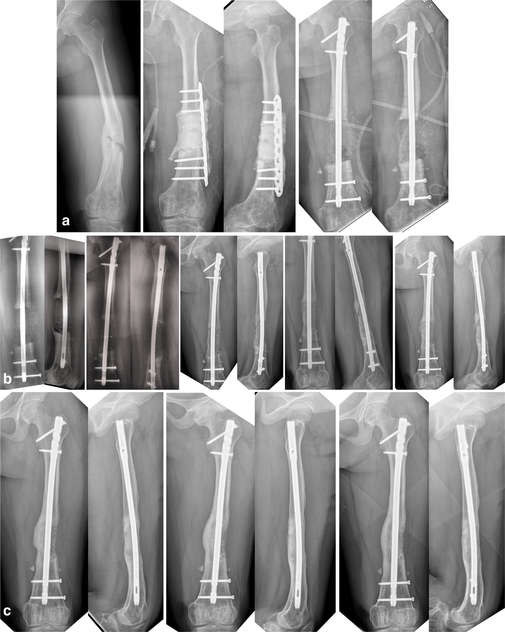 Fig. 4 
          Radiographs demonstrating the healing process of a 14-year-old female patient with bone defect of 70 ml in Group BMAA. a) Anteroposterior (AP) radiographs before first operation, AP and lateral radiographs after first and second operation. b) AP and lateral radiographs from 1, 3, 5, 7, and 9 months postoperatively demonstrating bony consolidation in the seventh month. c) AP and lateral radiographs from 1, 1.5, and 2 years after the second operation. BMAA, bone marrow aspirate mixed allograft.
        