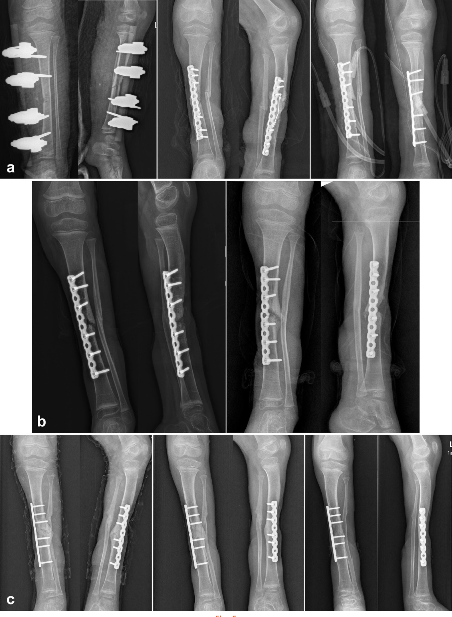 Fig. 5 
          Radiographs demonstrating the healing process of a seven-year-old female patient with bone defect of 20 ml in Group BMAA. a) Anteroposterior (AP) and lateral radiographs before first operation, after first operation, and after second operation. b) AP and lateral radiographs from 2 and 7 months postoperatively of second stage, demonstrating bone resorption in the grafting site and implant break. c) Additional procedures of bone grafting with bone marrow aspirate were done. AP and lateral radiographs from 3, 5, and 18 months postoperatively of the third revision surgery, demonstrating bony consolidation in the third month. BMAA, bone marrow aspirate mixed allograft.
        