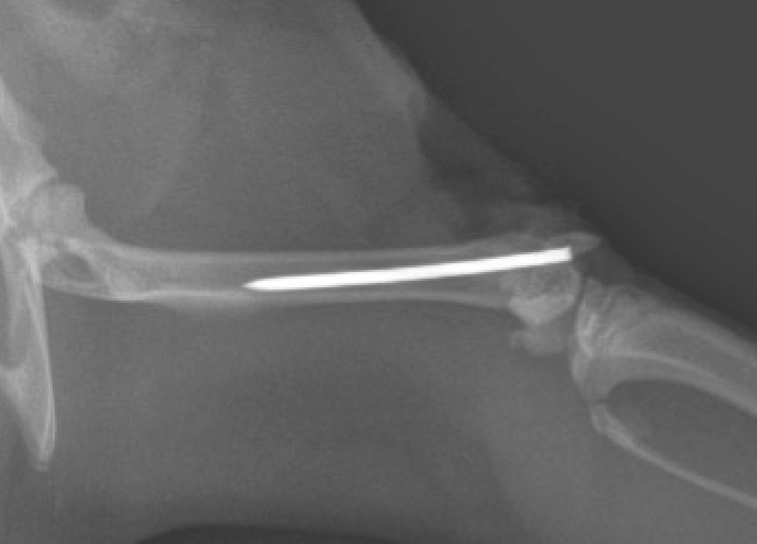 Fig. 2 
            Representative lateral radiograph after intra-articular implant. A unilateral suprapatellar arthrotomy was performed. A sterile operation-grade Kirschner wire (diameter, 0.088 mm; length, 20 mm) was inserted into the canal of the rat’s femoral bone, and the protruding part of the wire was positioned in the knee joint. Then, the joint and skin incision was closed with 4 to 0 sutures after irrigation by ethylenediaminetetraacetic acid dissolved in normal saline.
          