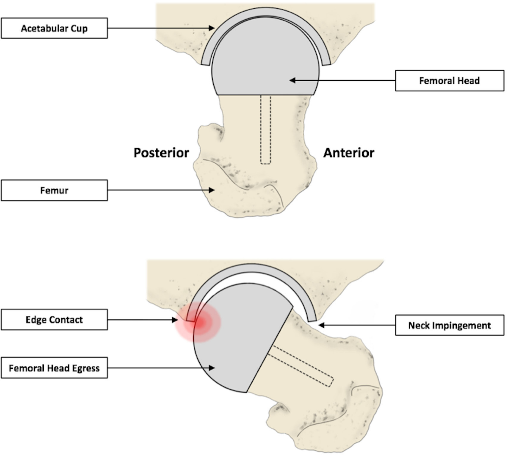 Fig. 10 
          A schematic diagram representing posterior edge contact, caused by instances of anterior impingement. Edge-wear can occur at the egress site, as the femoral head is levered out of the acetabular cup.
        