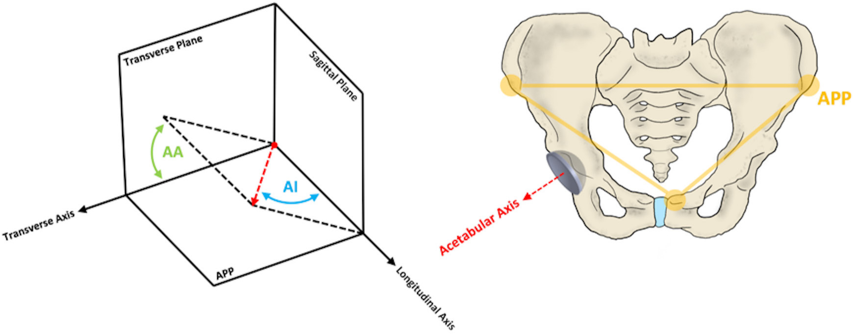 Fig. 2 
            A schematic diagram demonstrating the definition of the anterior pelvic plane (APP) and the measurement of anatomical acetabular cup inclination (AI) and anteversion (AA). The APP forms the coronal plane, from which the sagittal and transverse planes can be defined. The acetabular axis intersects the centre of the cup and is perpendicular to the cup rim plane.
          