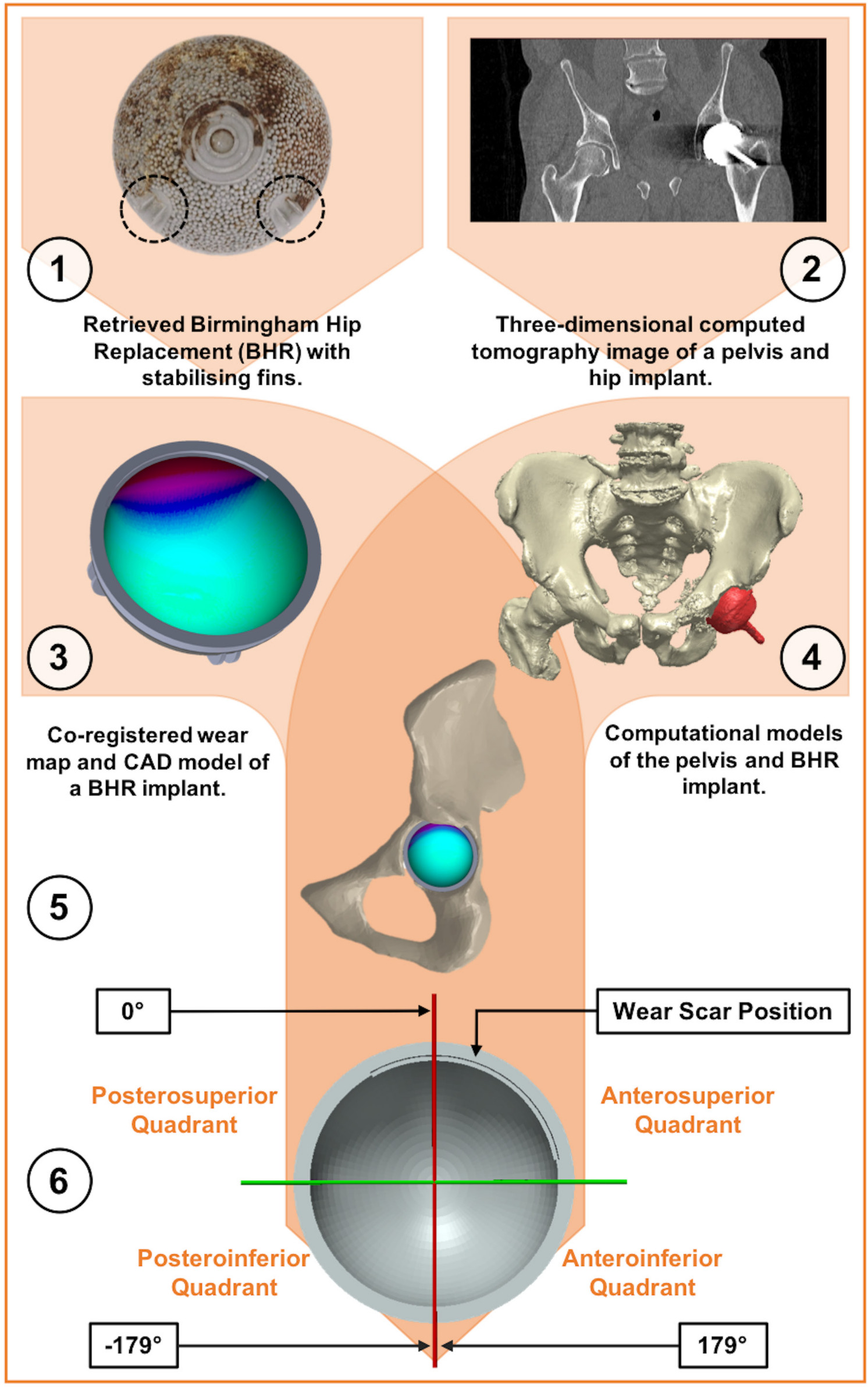 Fig. 3 
            A schematic diagram depicting the process of locating acetabular edge-wear in vivo. 1) A macroscopic image of a retrieved Birmingham acetabular component (backside), where its stabilizing fins have been circled. 2) A single slice of a pelvic CT scan, which includes a cobalt-chromium-molybdenum (CoCrMo) Birmingham hip replacement (BHR) metal implant. 3) A wear map co-registered to a BHR (52 mm) computer-aided design (CAD) model. 4) Computational models of the pelvis and BHR implant, segmented from a 3D CT scan. 5) A BHR implant CAD model and wear map, co-registered to the computational model of the actual implant within the pelvis. 6) A perpendicular view of the acetabular cup and its measurement axis, where the Cup-APP (CAPP) plane defines the 0° and 180° positions. Anterior and posterior locations of edge-wear were defined by positive and negative angles, respectively.
          