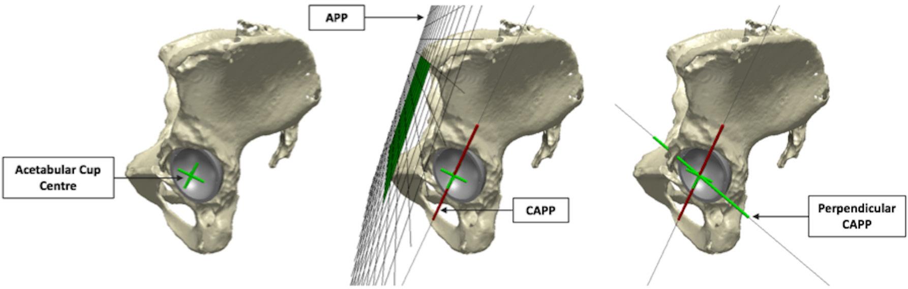 Fig. 4 
            Computational models of a pelvis and Birmingham hip replacement (BHR) implant, generated within Simpleware ScanIP. The "For Review Only" standardized reference system defined to measure the in vivo location of edge-wear is illustrated (Cup-APP (CAPP)), which is parallel to the anterior pelvic plane (APP) and intersects the centre of the cup opening.
          