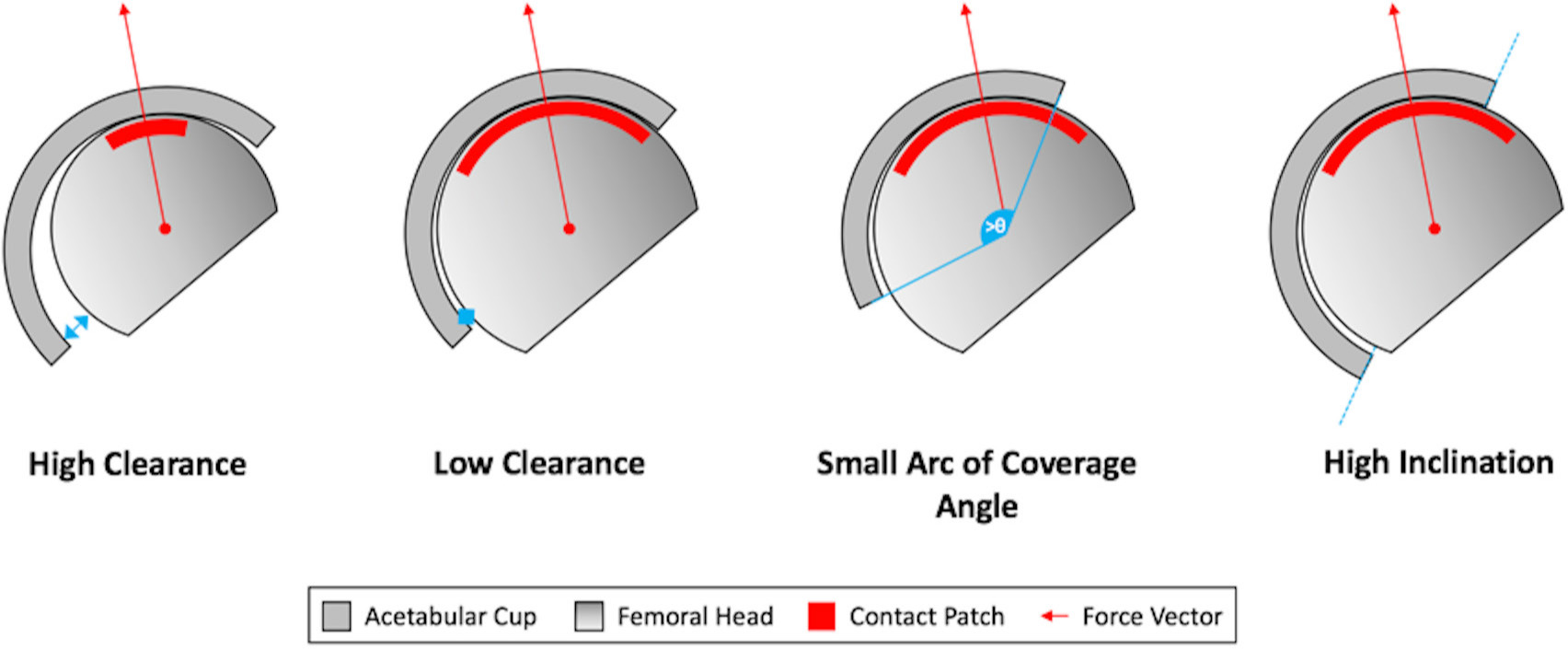 Fig. 9 
          A schematic diagram depicting the influence of clearance, arc of coverage angle, and acetabular inclination on the location of the bearing contact patch location.
        
