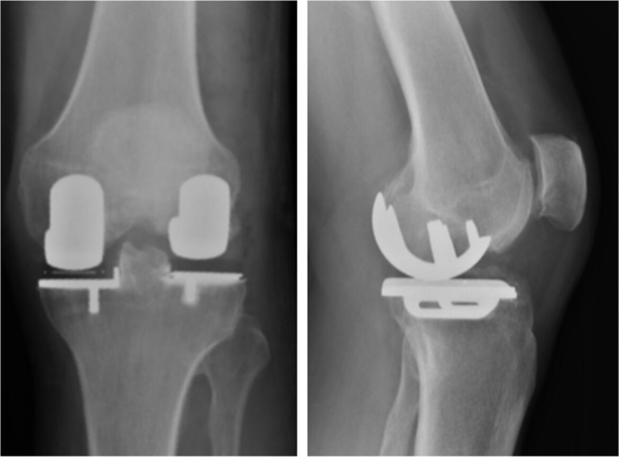 Fig. 1 
          Anterior-posterior and lateral radiographs of the left knee with bi-unicondylar arthroplasty in situ.
        